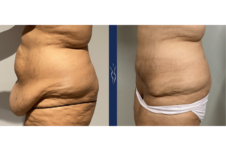 Fleur-de-Lis Tummy Tuck