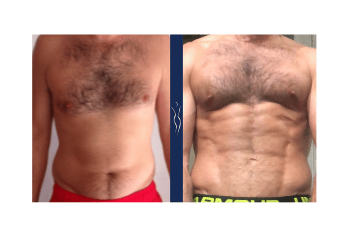 What is the Recovery Time for Liposuction?