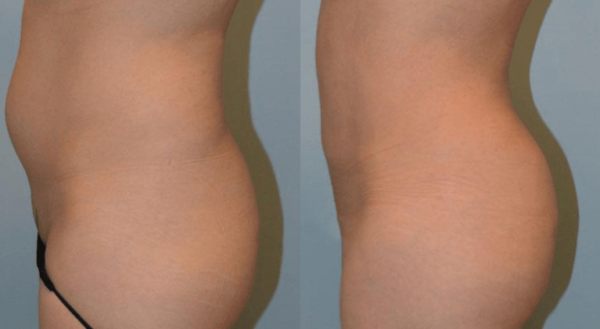 How to Shape Your Butt: Fat, Fillers, or Implants?