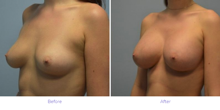 Breast Augmentation Results Nashville