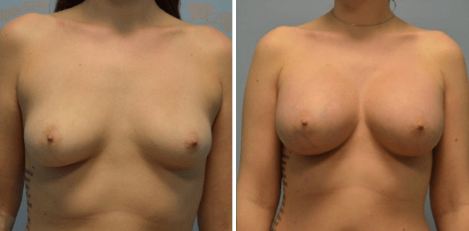 Breast Augmentation Nashville