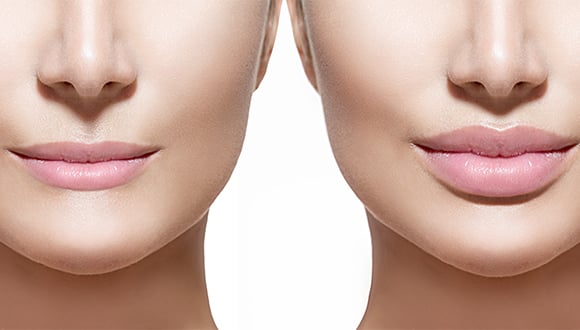Which Dermal Filler Is Best for Lip Augmentation?