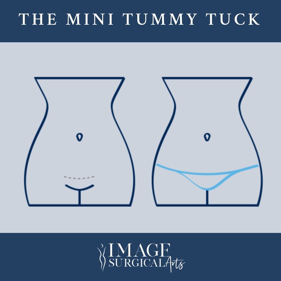 What is a Mini Tummy Tuck?
